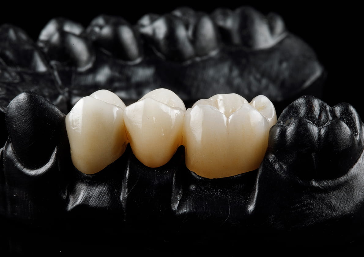 セラミック治療