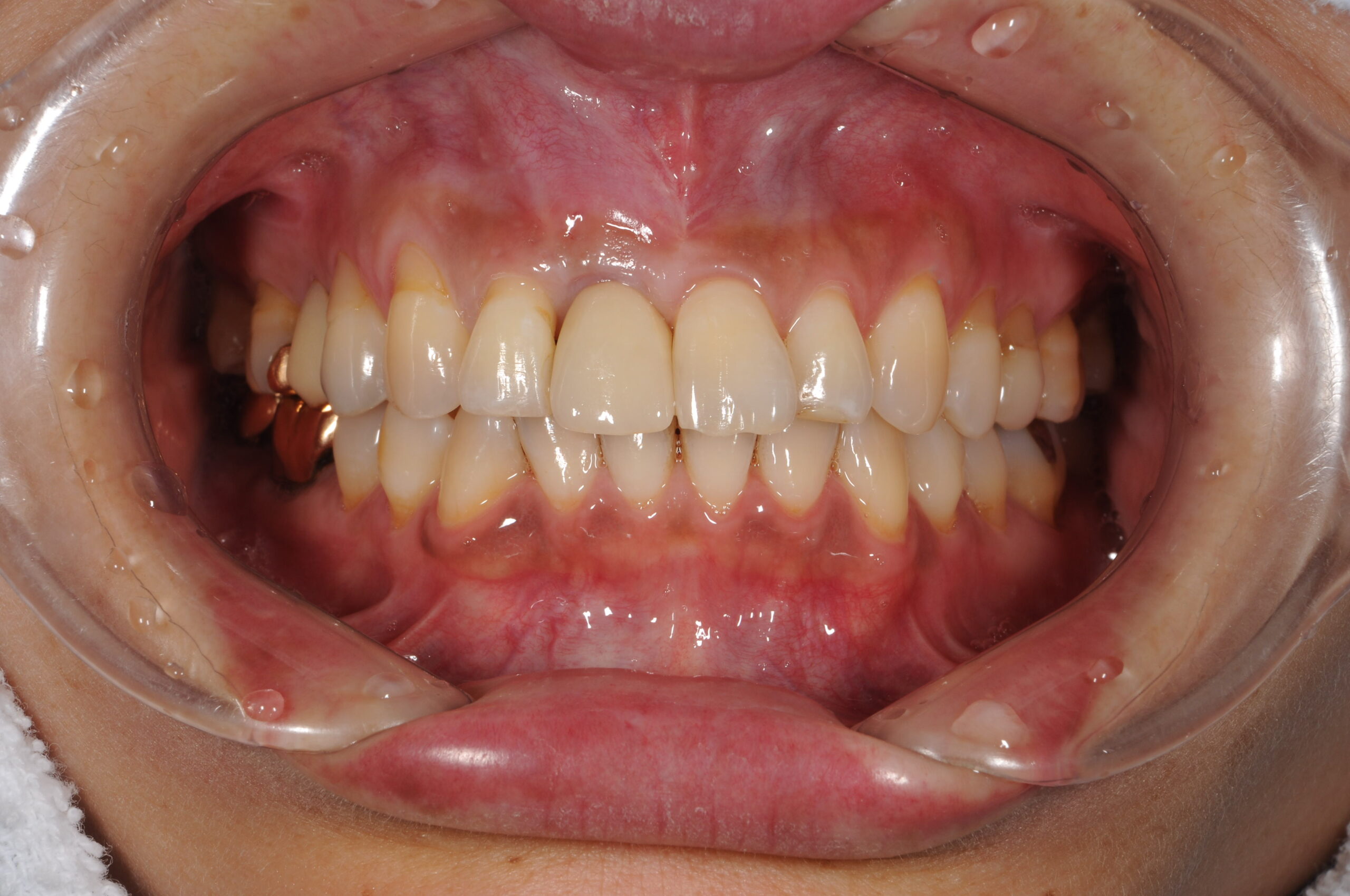 前歯のインプラント治療