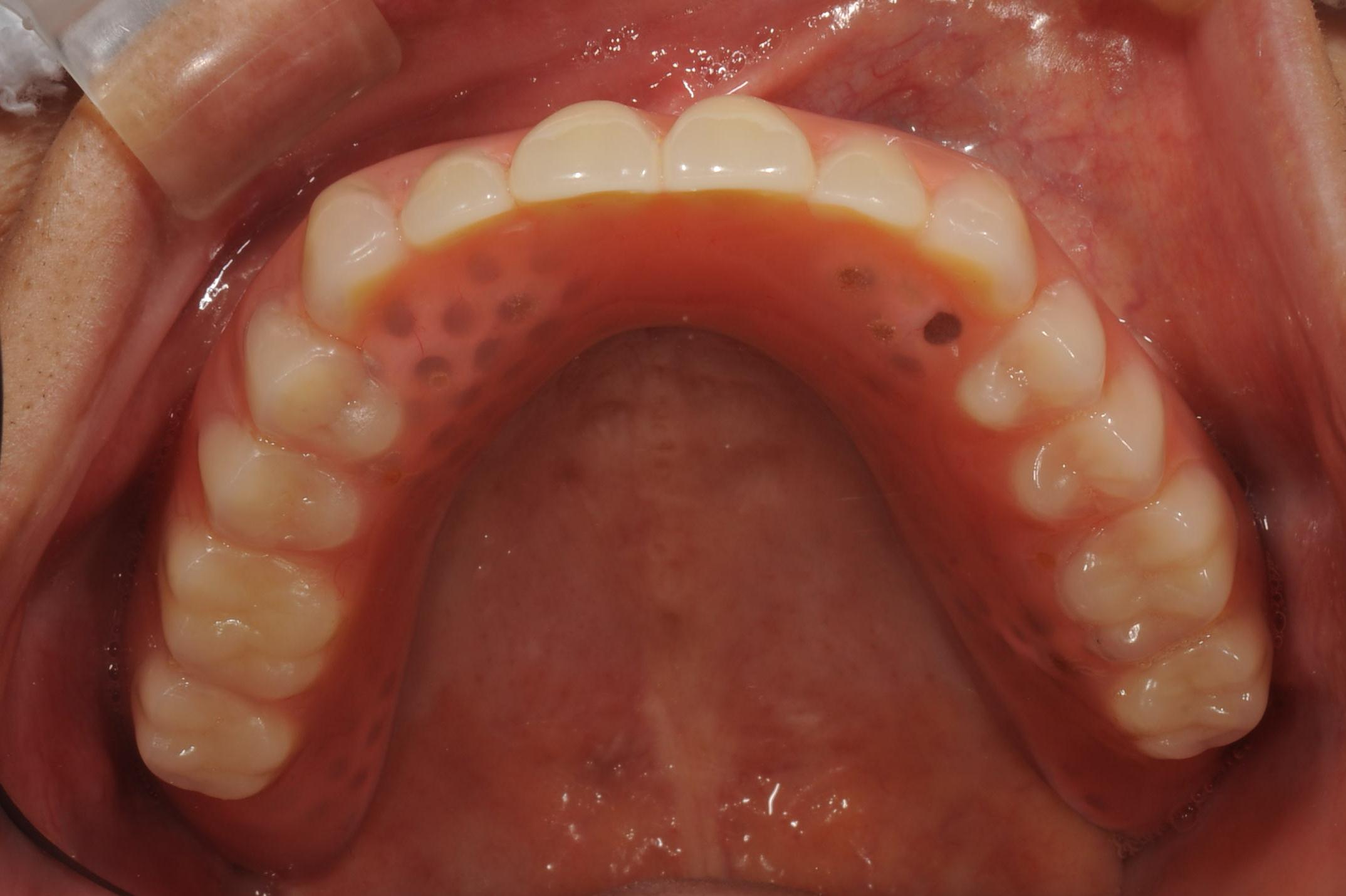外れない入れ歯