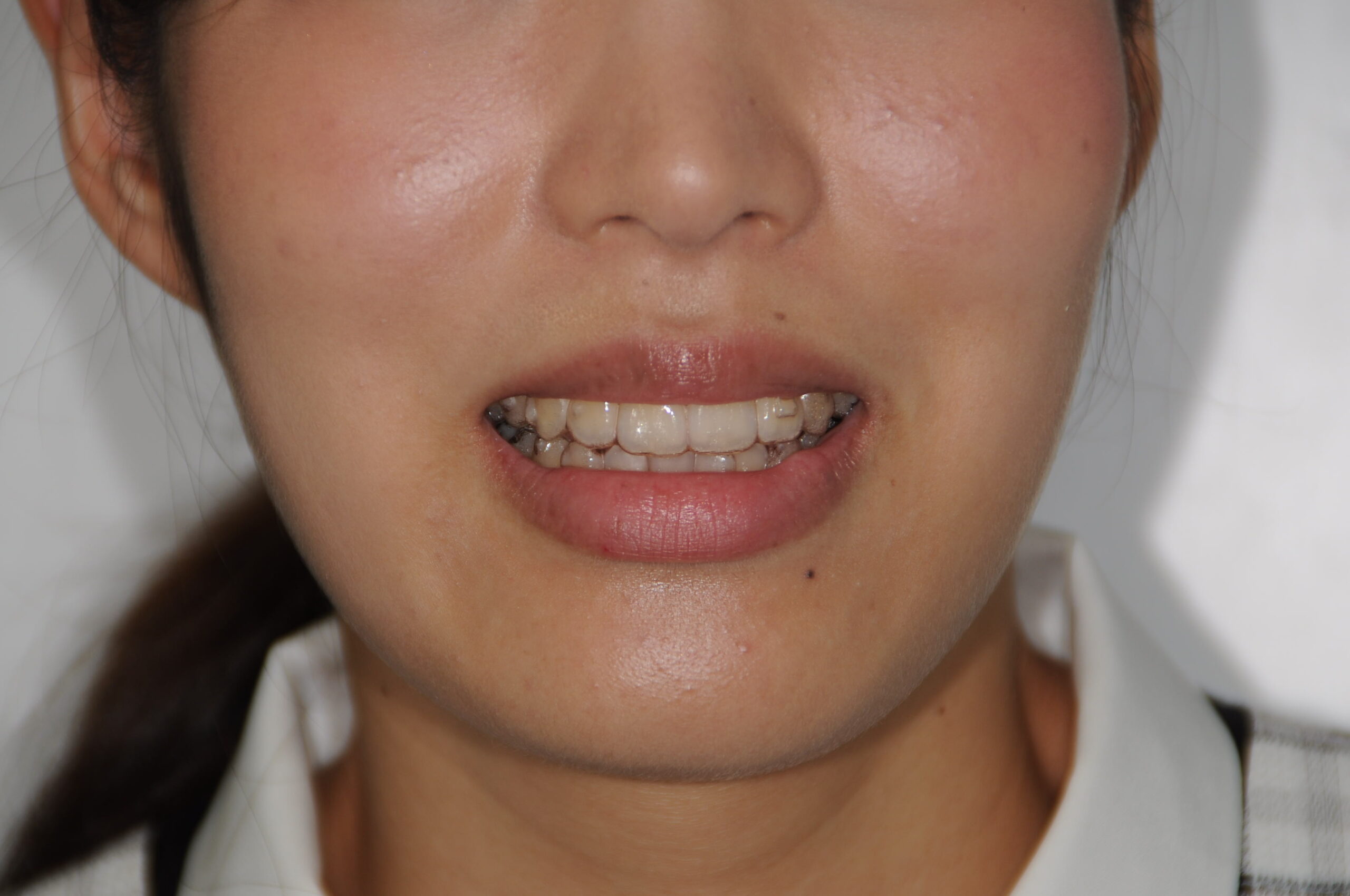 インビザラインでの矯正治療