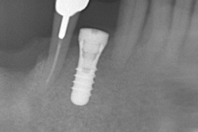 インプラント手術