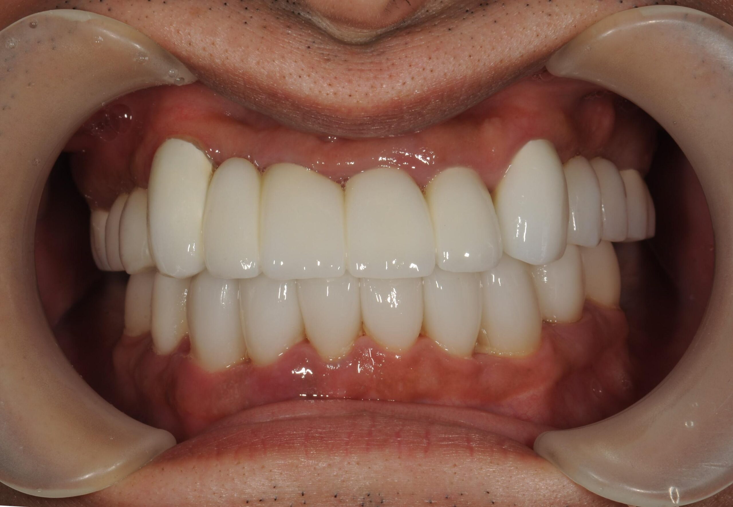 セラミックでの歯並び治療(^^♪