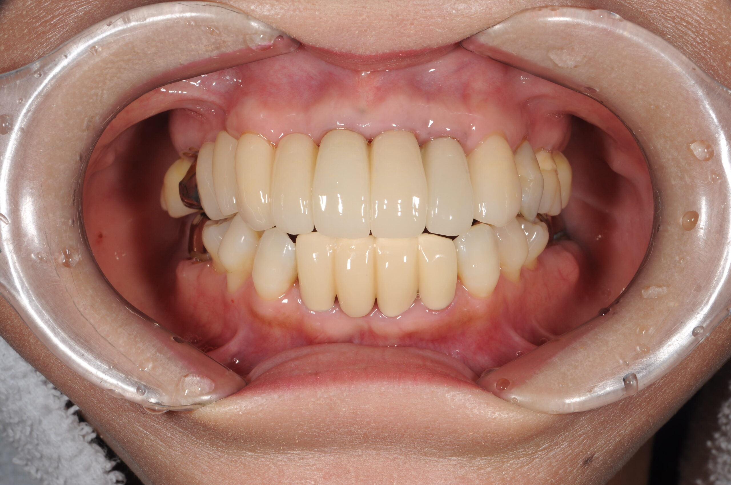 セラミックでの短期矯正治療で美しい歯並びを(^^)/