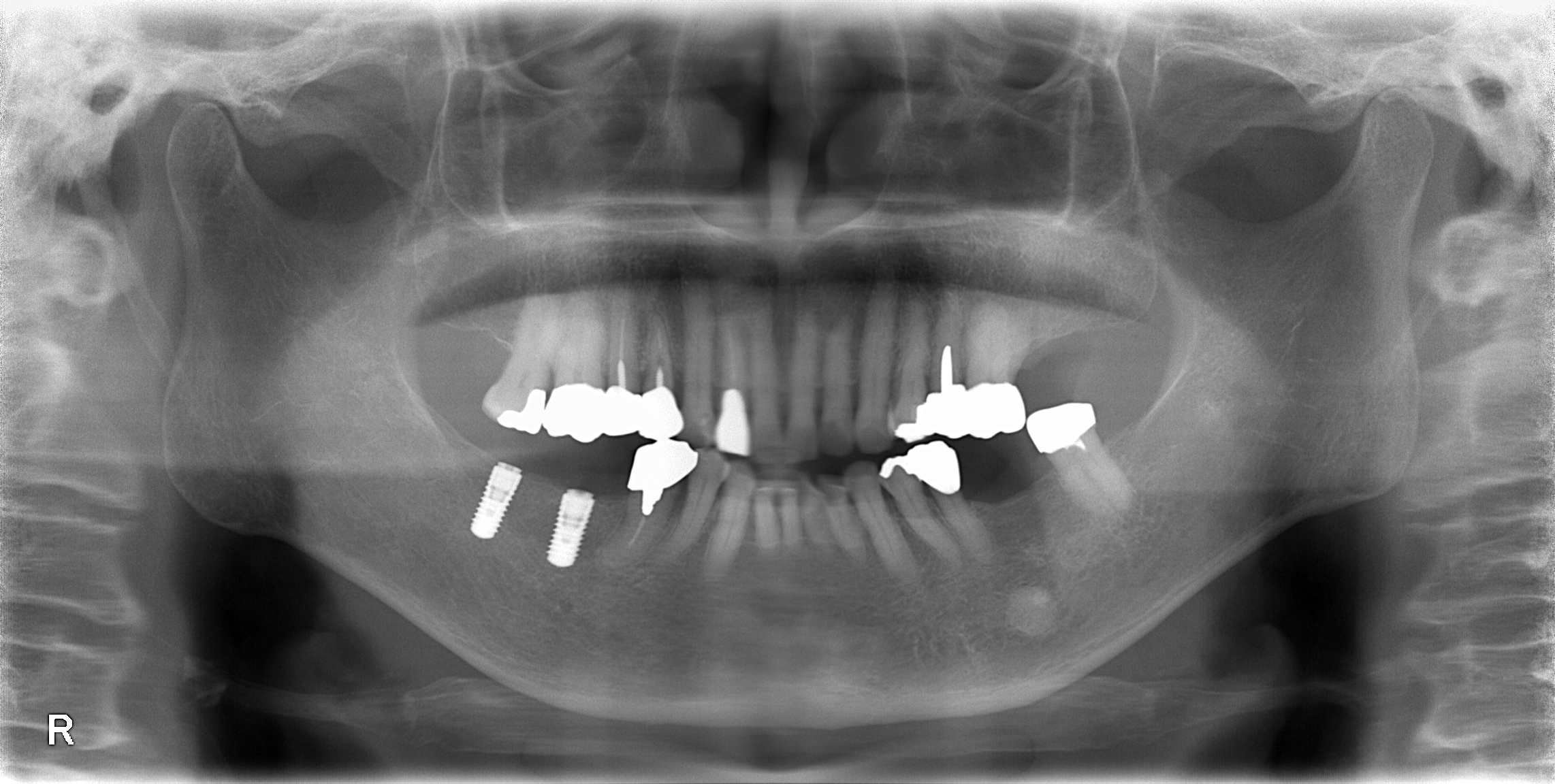 インプラント手術行いました！