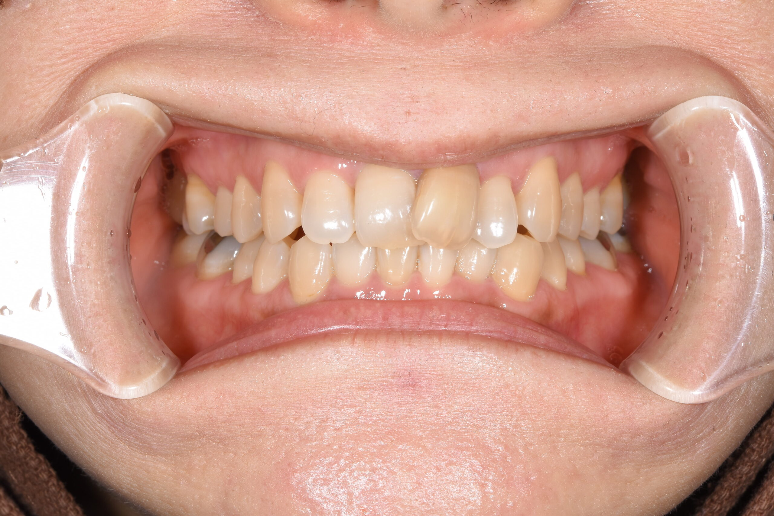 セラミック矯正で美しい歯並びに(^^)/