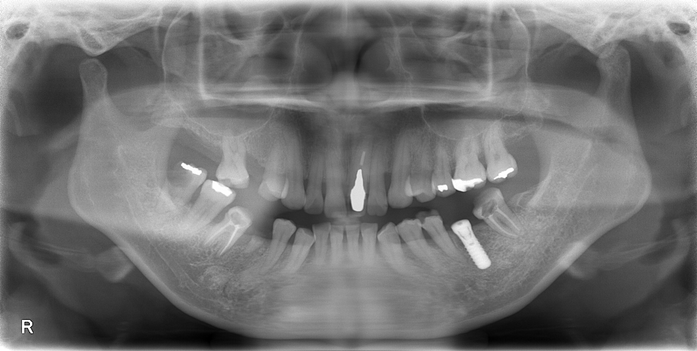 痛みのない理想的なインプラント手術！