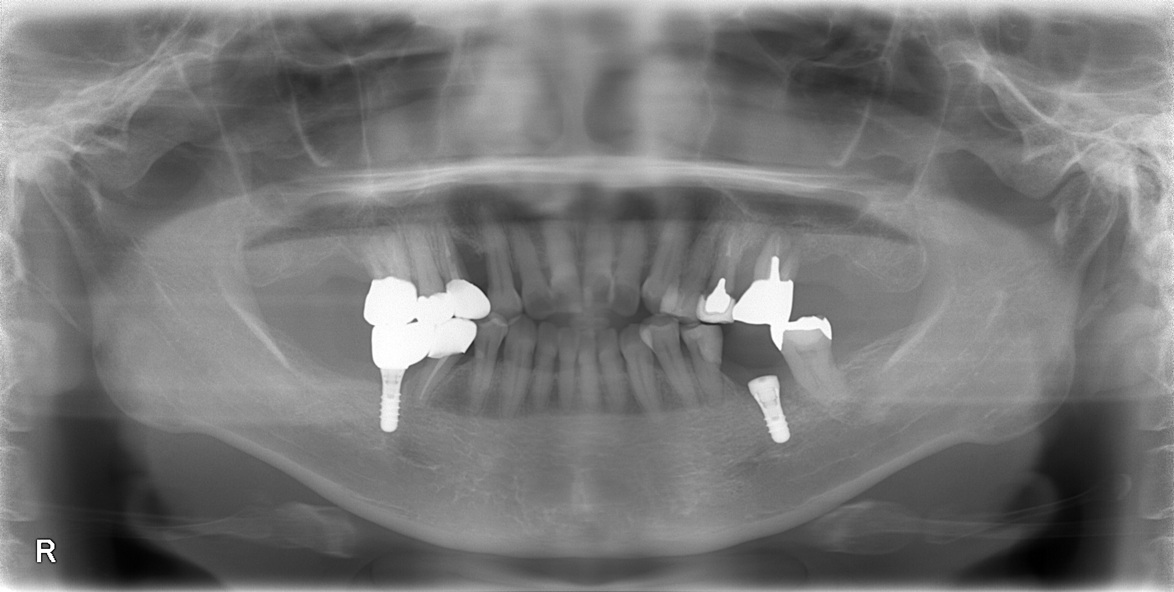 インプラント手術です。