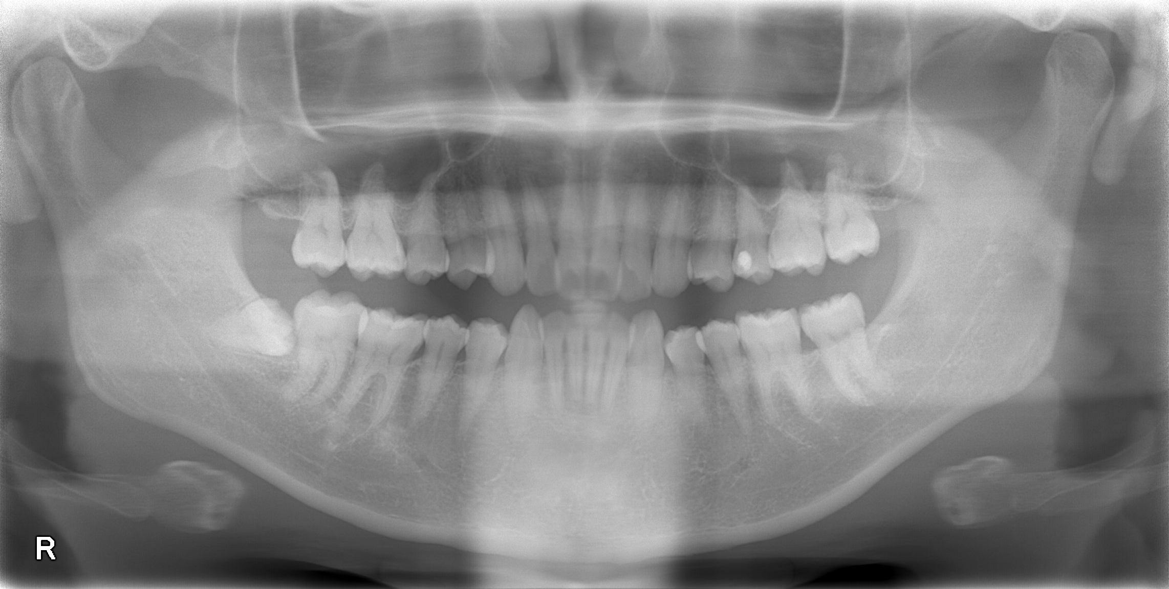 歯茎に埋まった親知らずの抜歯です