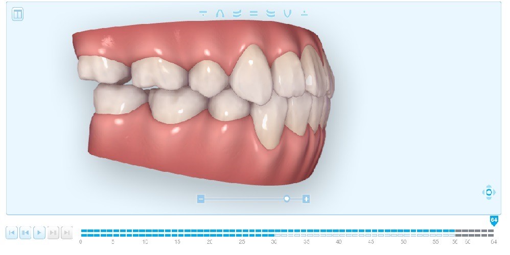 矯正治療　当院ならここまでできます(*^-^*)
