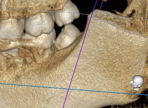 CT撮影を行った親知らずの抜歯　