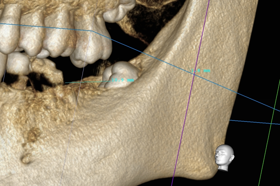 歯茎の下にほぼ全て埋まった親知らずの抜歯