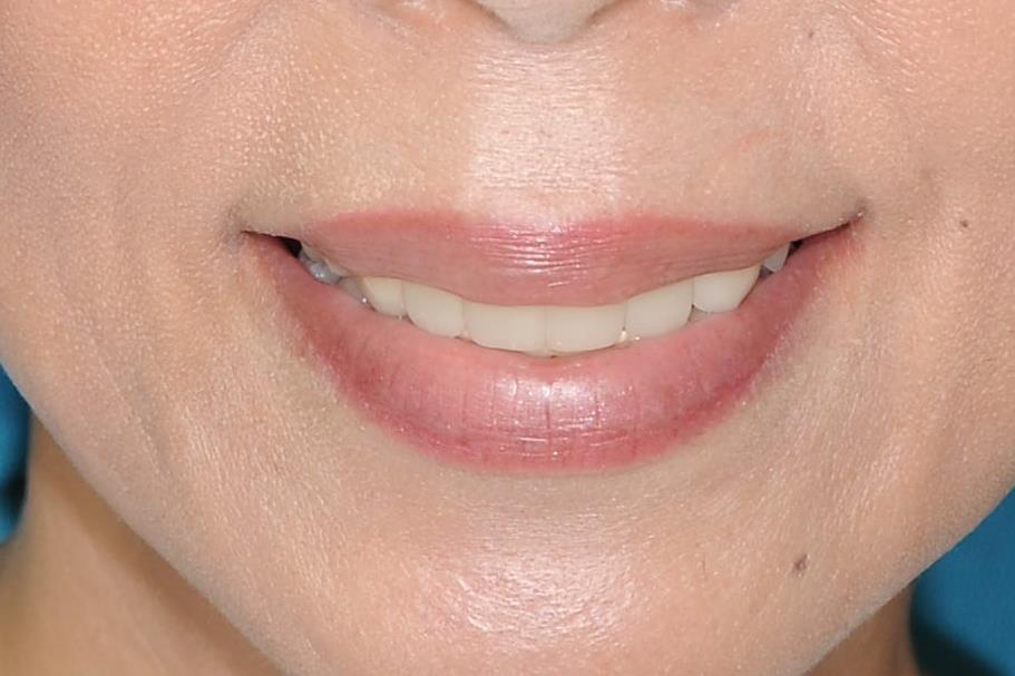 前歯すきっぱ・ガタガタ・出っ歯　一気に美しく改善できます(*^-^*)