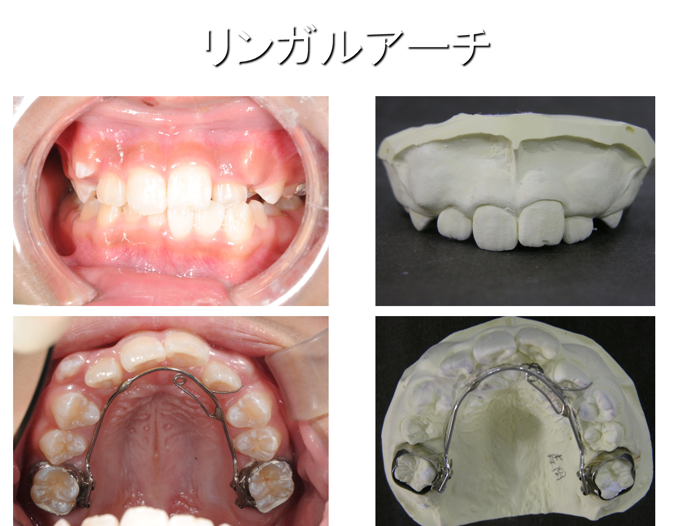 7歳の矯正治療(^^)/