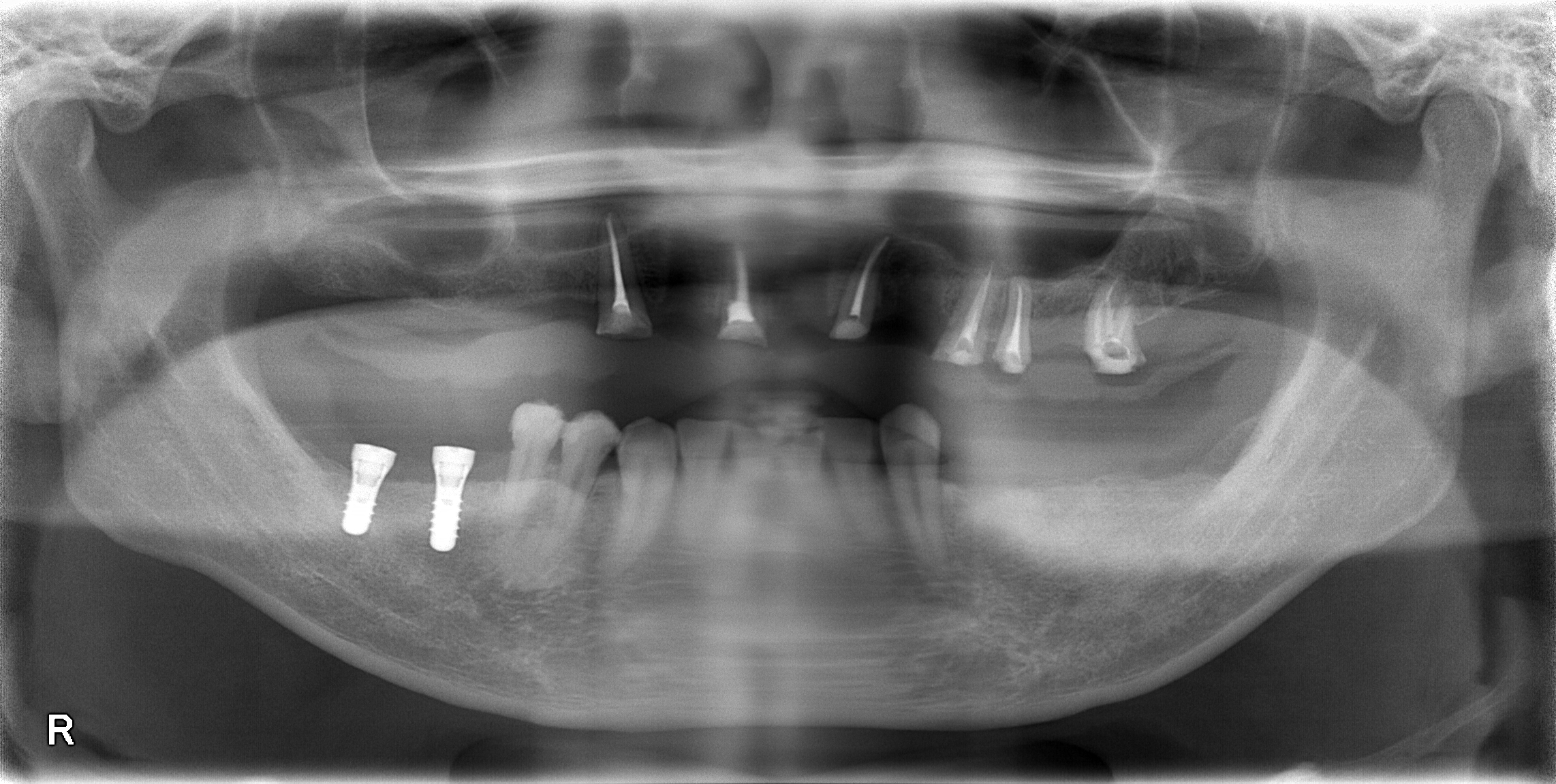 重度虫歯からのインプラント・入れ歯治療(*^-^*)