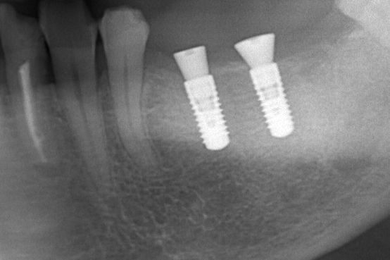 2021年初投稿　インプラント治療　