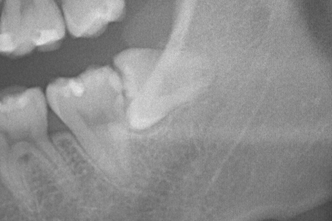 横向きに生えた親知らずの抜歯