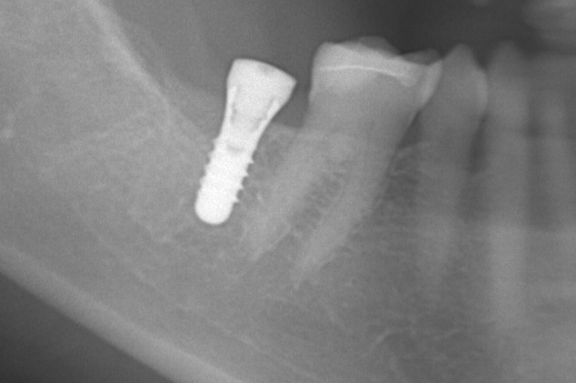 インプラント手術　