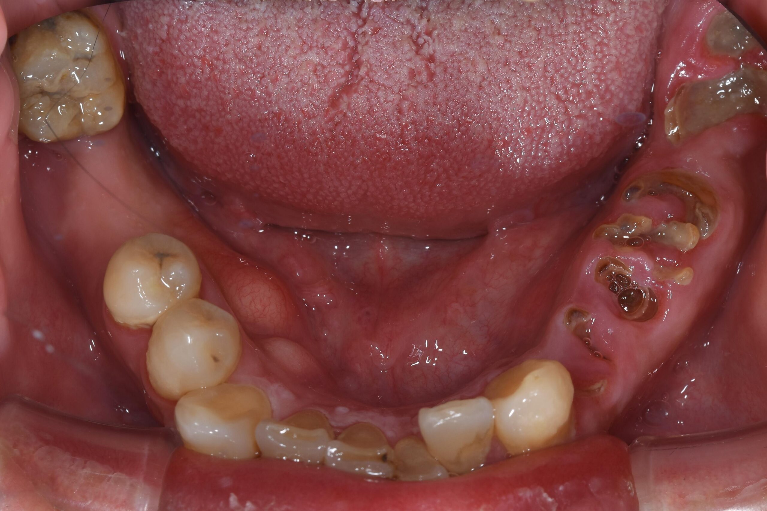 インプラント・セラミックを使用した全顎治療の１例