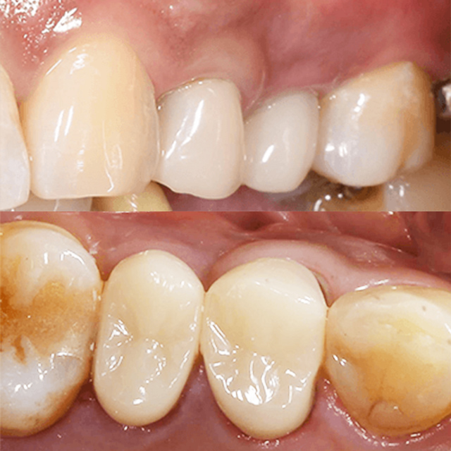 CAD/CAM（キャドカム）冠
