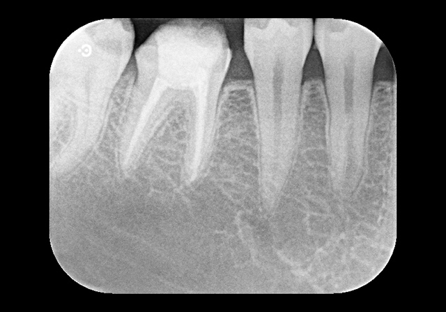 緊密な根管充填